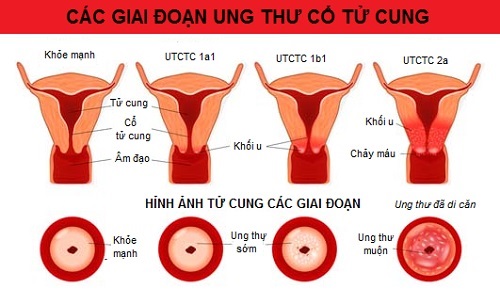 Ung thư cổ tử cung - Hình ảnh minh họa